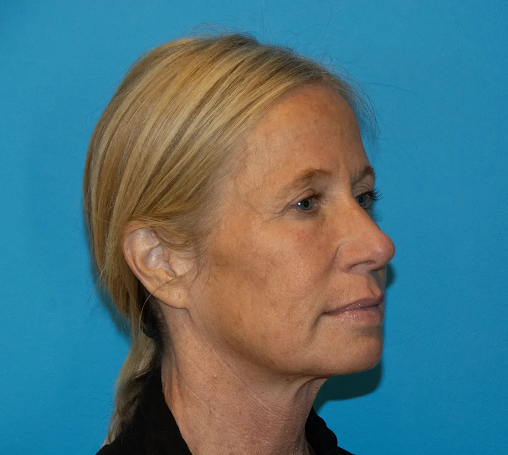 browlift 29876 5 of 6