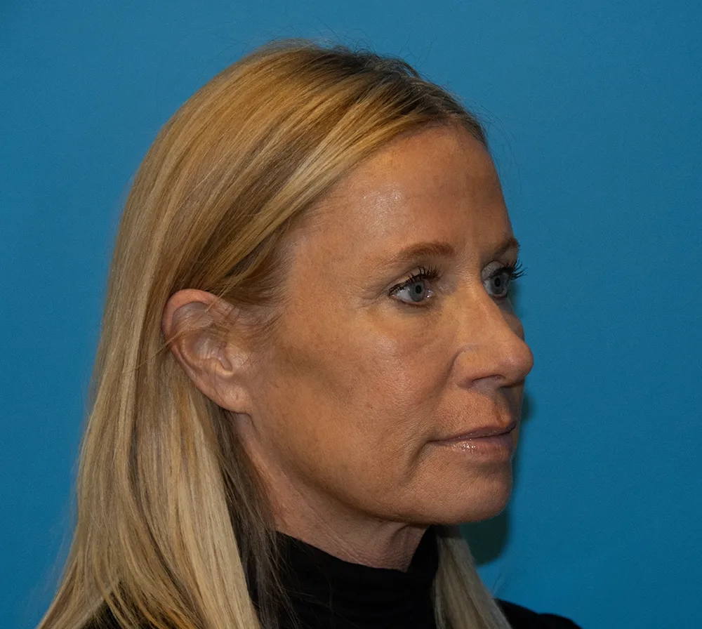 browlift 29876 6 of 6