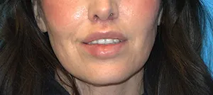 Lip Lift patient 30587 after cropped