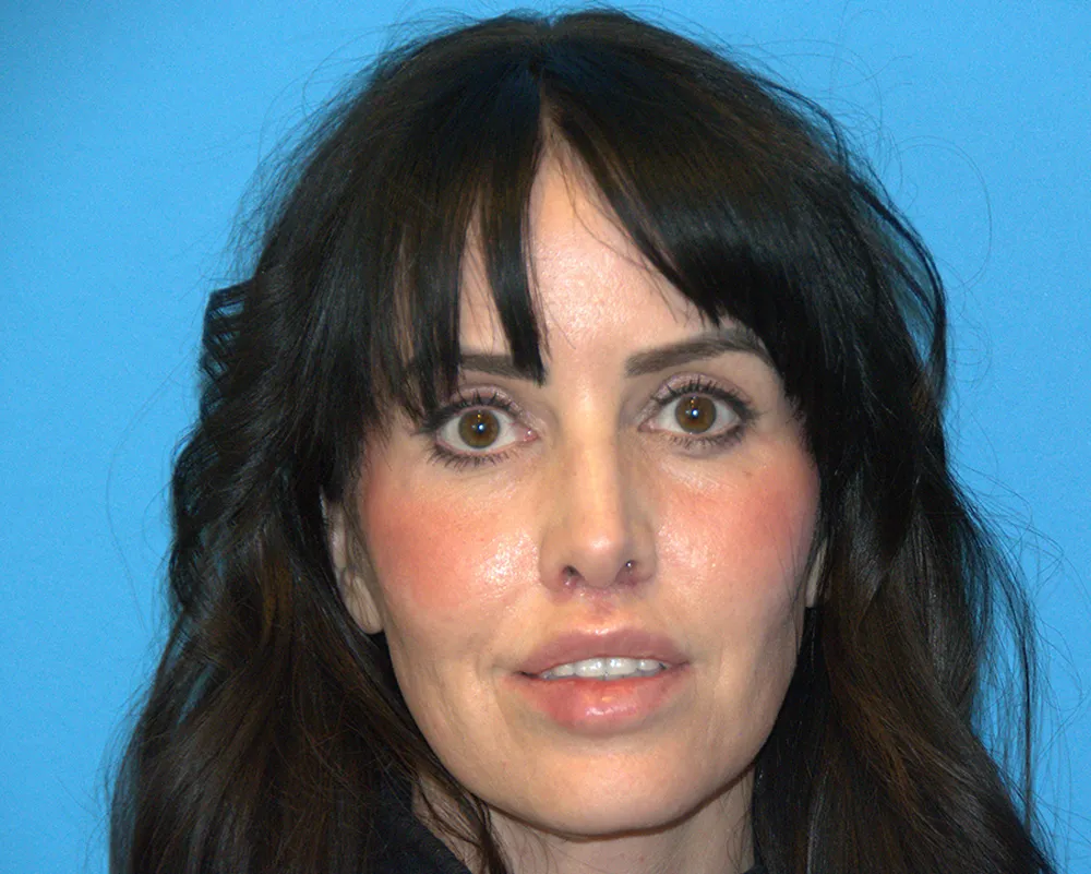 Lip Lift patient 30587 after