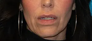 Lip Lift patient 30587 before cropped