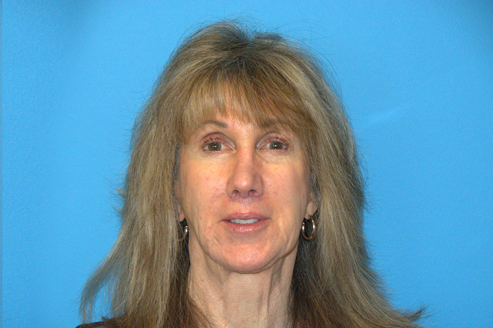 Lip lift patient 30656 after