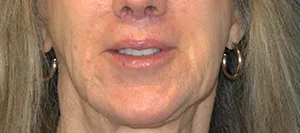 lip-lift-after-slide