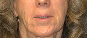 lip-lift-before-slide
