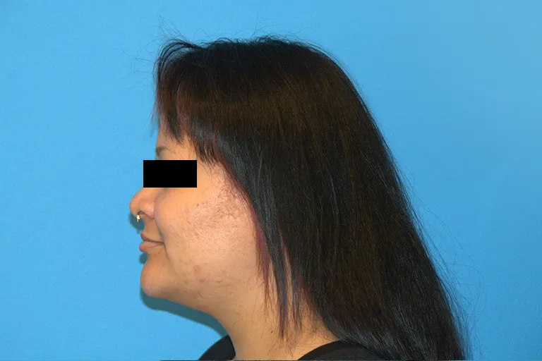 face-lipo-after