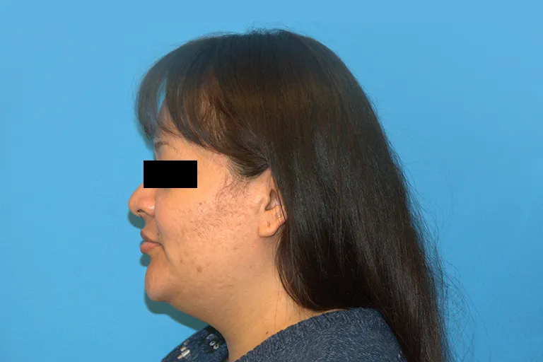 face-lipo-before