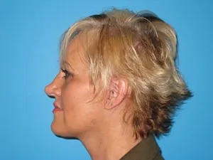 facelift patient side view
