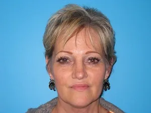 facelift patient