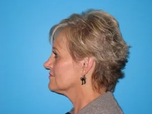 facelift patient side view