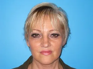 facelift patient