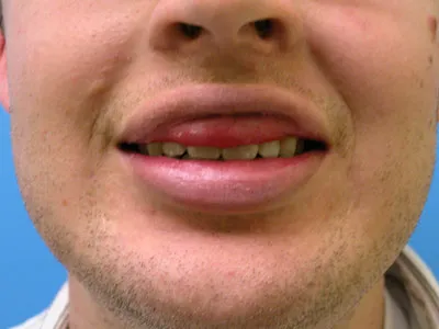lip-surgery-before