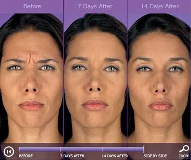 botox example
