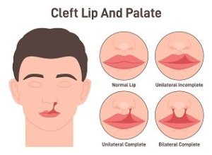 Illustration of cleft lip and palate showing a comparison between a normal lip and different types of cleft conditions: unilateral incomplete, unilateral complete, and bilateral complete